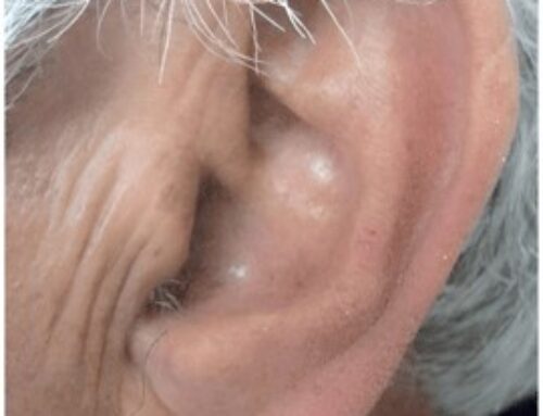 TN50#173_Ear Creases And Other Signs You May Have Heart Disease